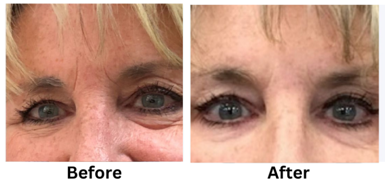 Revanesse Dermal Filler Before After Pictures