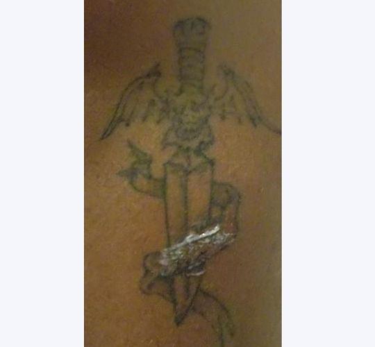 Laser Tattoo Removal Kansas City