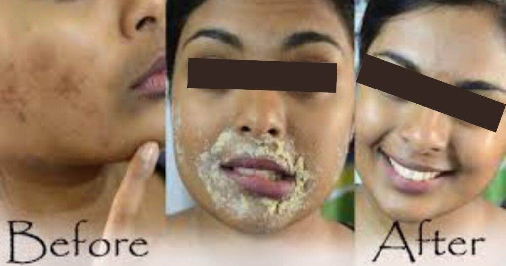 How to Get Rid of Hyperpigmentation