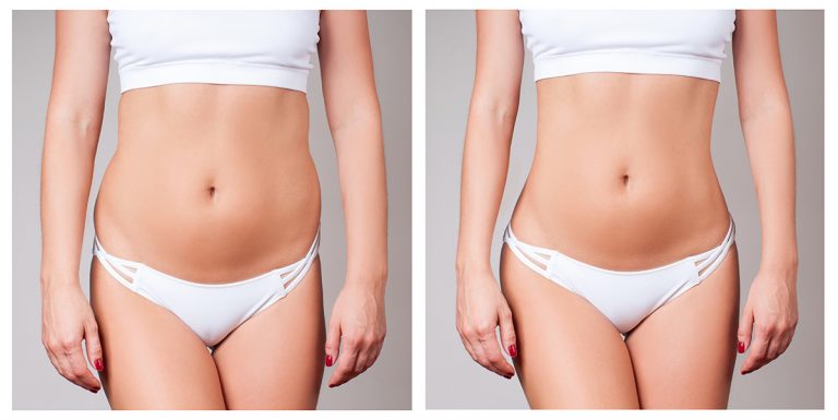 Non Surgical Fat Reduction