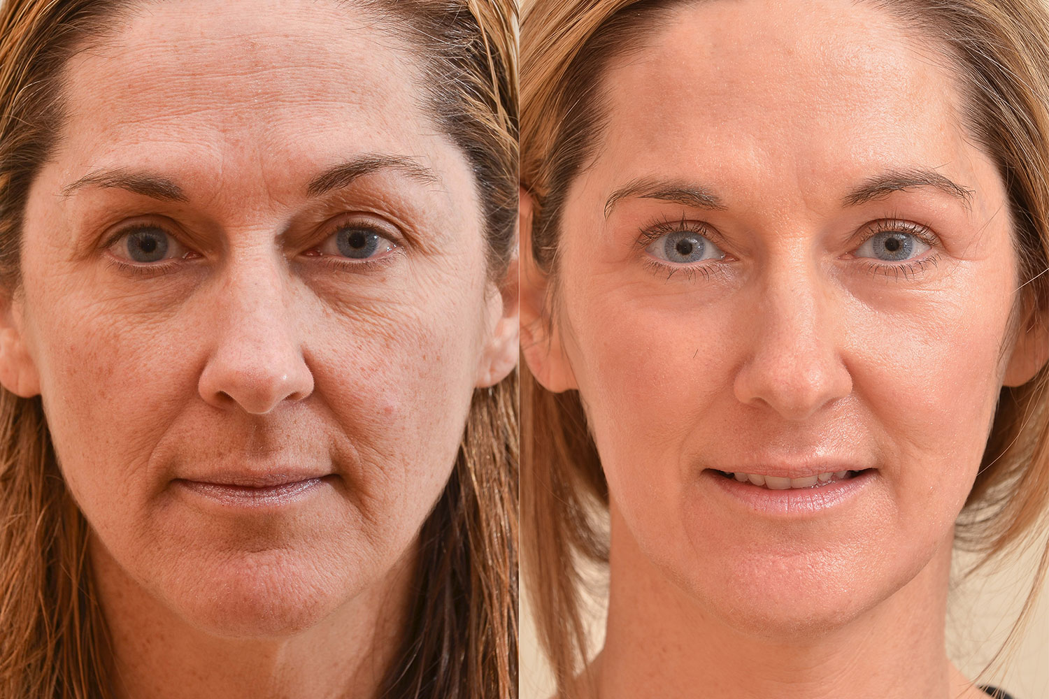 The newest in resurfacing and skin tightening treatments