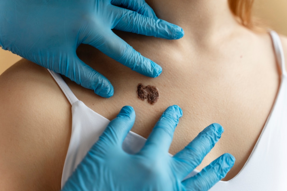 Moles and Lesion Removal