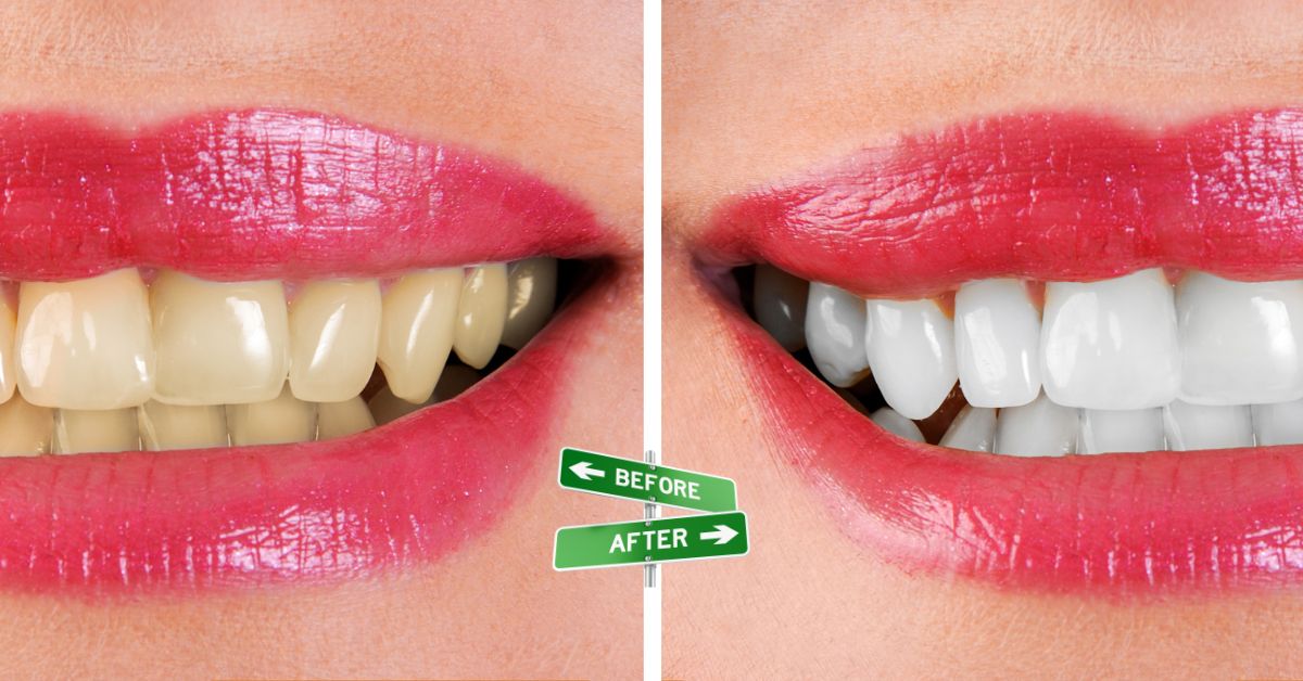 How Long Does Teeth Whitening Take