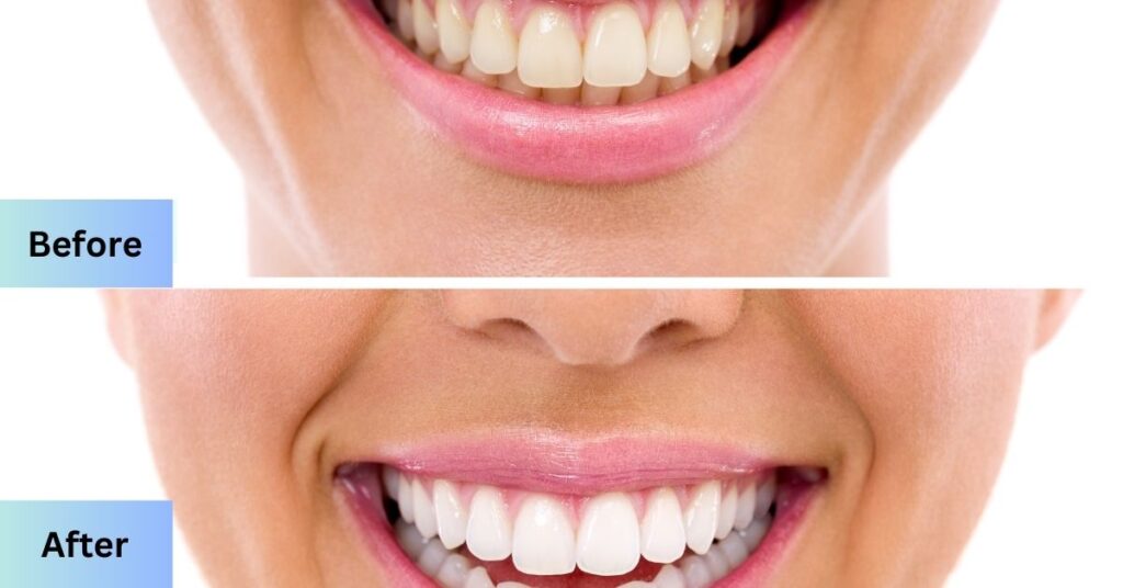 Teeth Whitening Pros and Cons