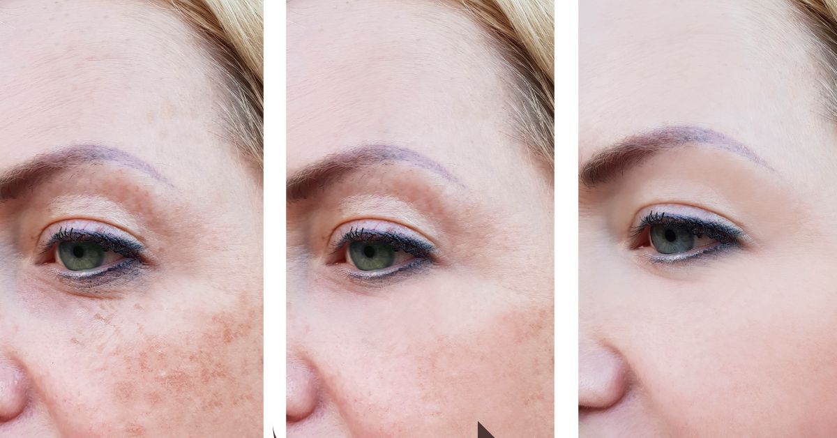 40 units of botox before and after