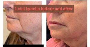 1 Vial Kybella Before and After