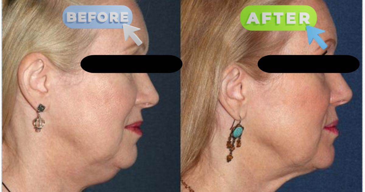 Kybella before and after