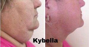 Kybella Before and After: What to Expect