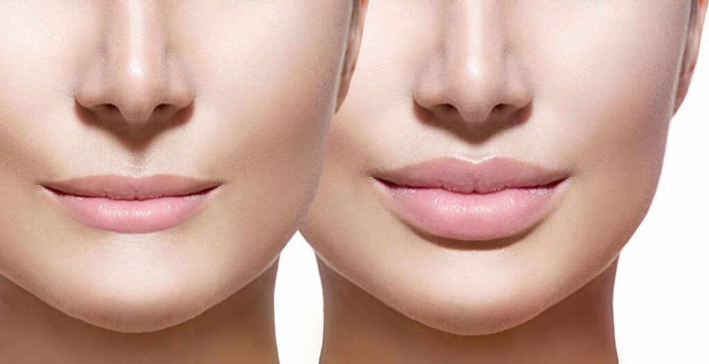 Long-term Effects of Lip Fillers