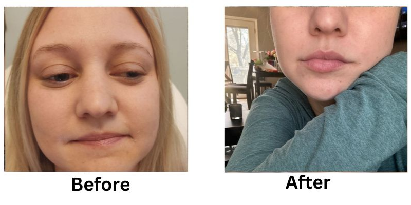 Lip Filler Before and After