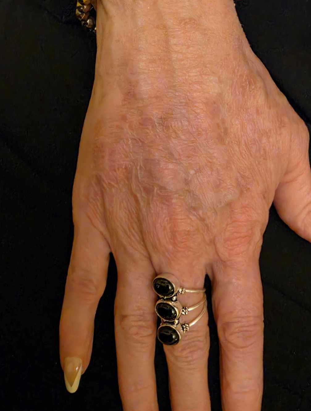 Radiesse Hand after