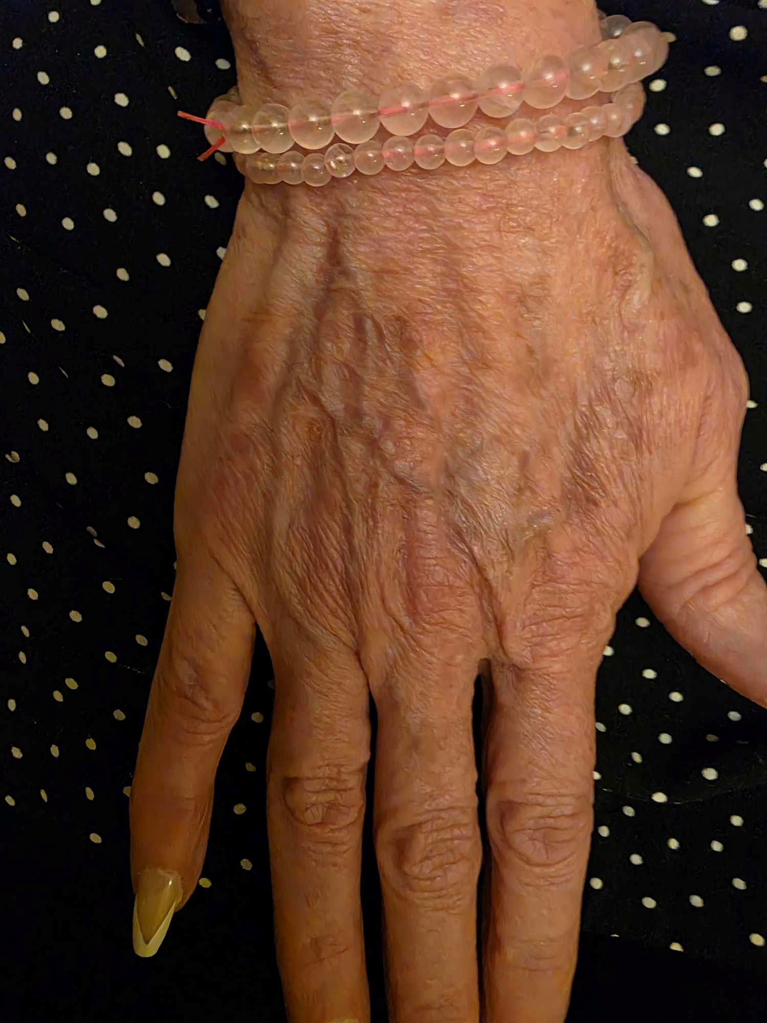 Radiesse Hand before