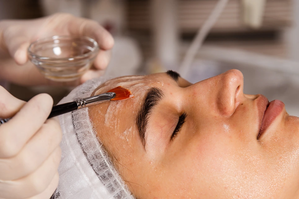Chemical Peels For Pigmentation