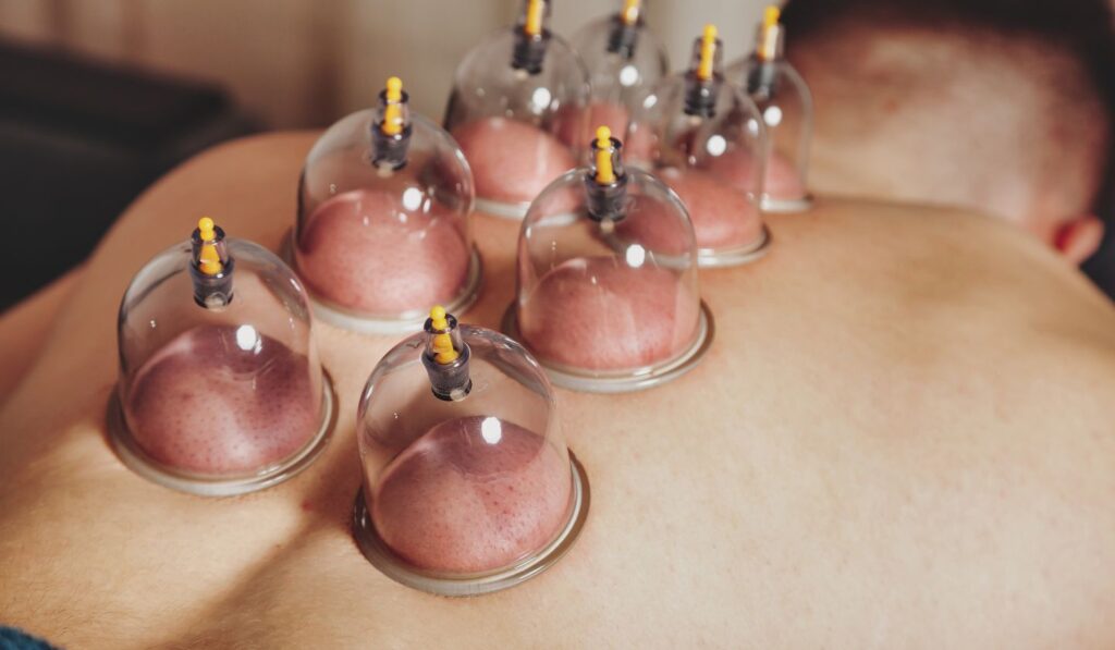 Cupping Massage vs. Swedish Massage