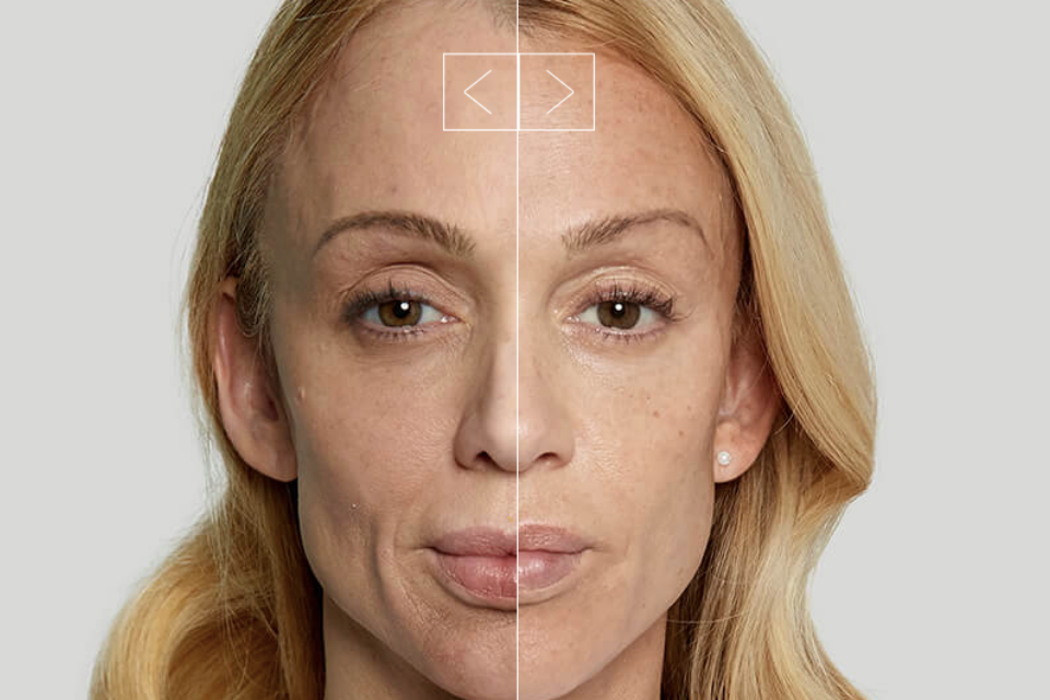 What Is Sculptra And How Is It Different From Filler