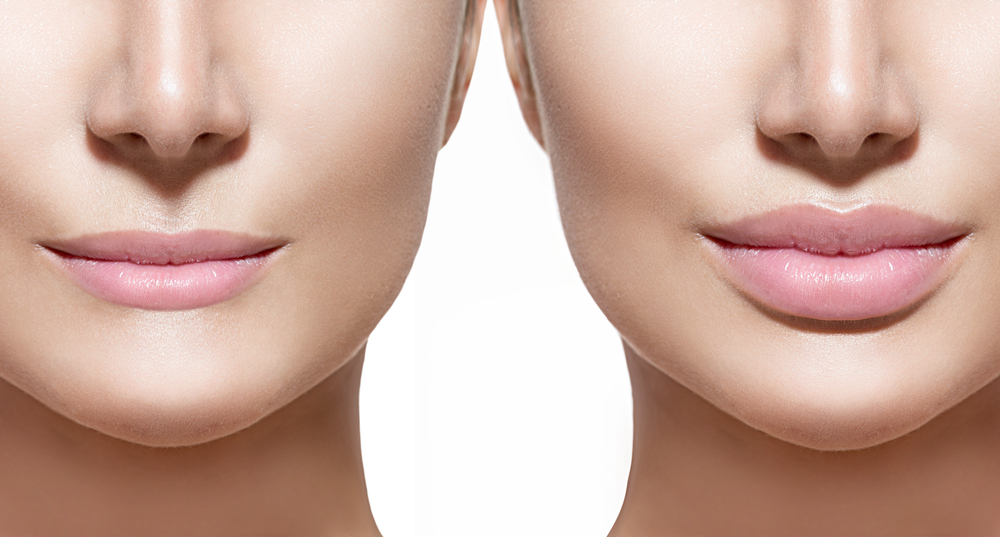 What Is The Best Filler For Thin Lips?