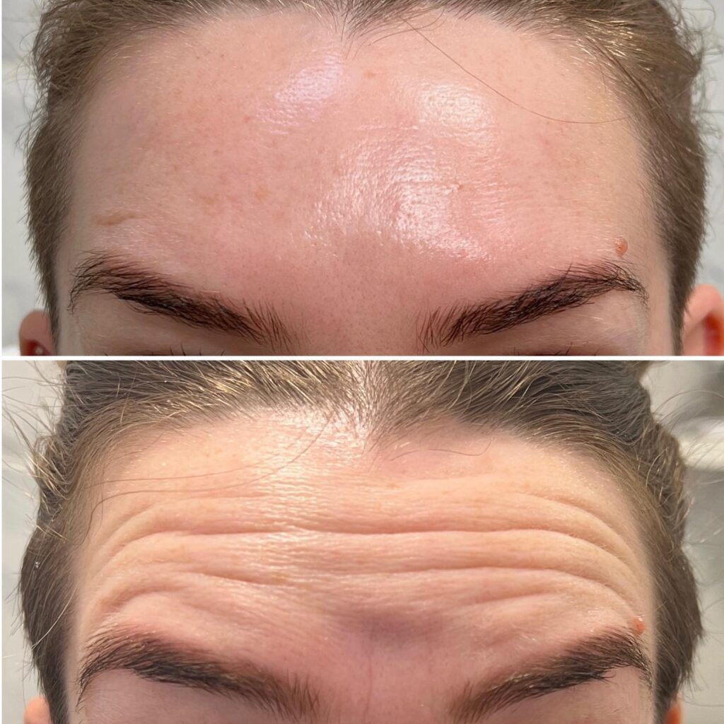 What Is The Best Treatment For Deep Forehead Lines