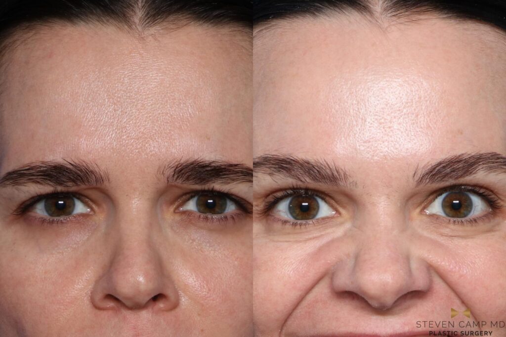 What is the difference between Botox and fillers