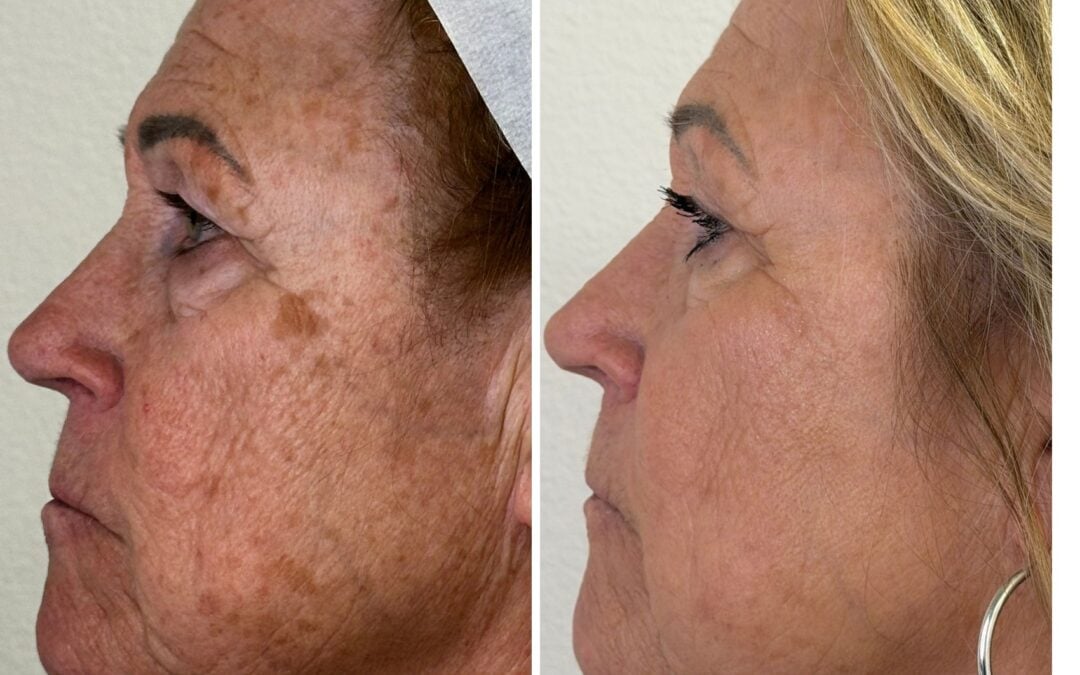 Skin texture refinement through layered treatments