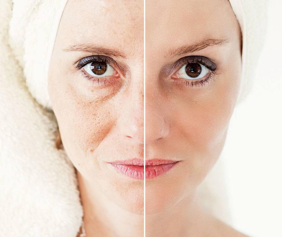 Non-surgical skin tightening approaches